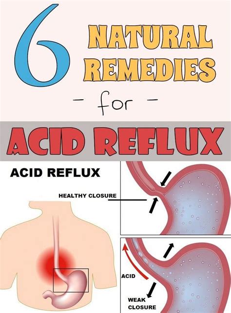 Acid Reflux Vomiting Relief